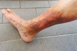 Penyebab Eksim di Kaki Faktor-faktor yang Perlu Anda Ketahui